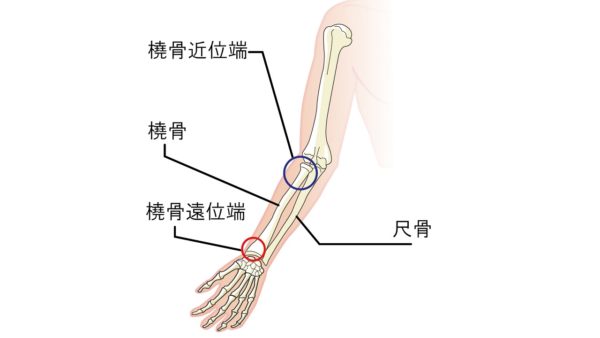 橈骨遠位端骨折